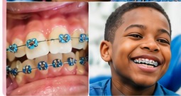 Young patient smiling with braces